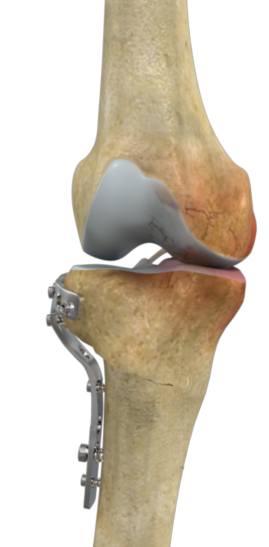 High Tibial Osteotomy