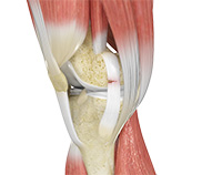 Ligament Injuries