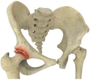 Osteoarthritis of the Hip