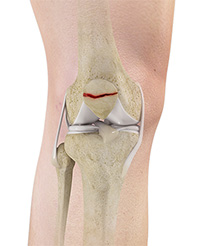 Patellar Instability