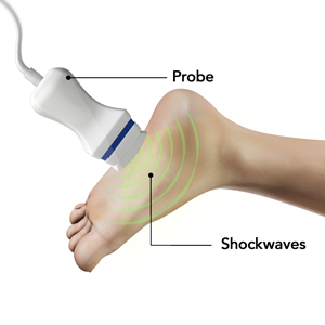 Shock-wave Therapy