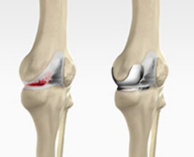 Unicompartmental Knee Replacement